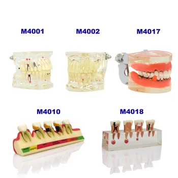 Дентална патология Модел на зъбите, Импланти за възрастни/Кариозные кисти за деца За стоматологични изследвания Патологична модел на пародонтоза