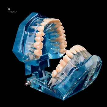 Модел патологични на зъбите С реставрационным мостовидным протеза Зъболекар за медицински науки Обучение стоматологическим болести Изследване на зъбни импланти